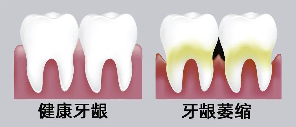 牙縫大露出“黑三角”，既塞牙又難看！還能恢復(fù)嗎？